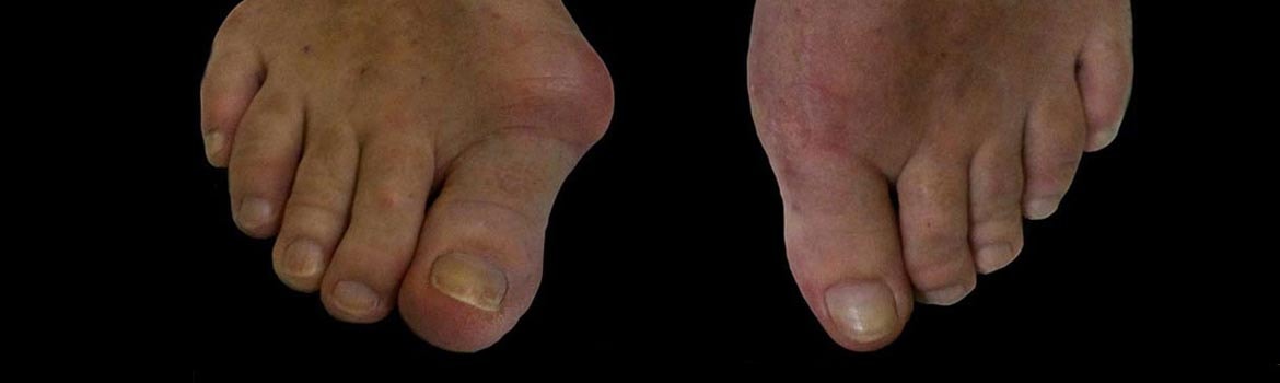 Foot with a bunion at the base of the big toe