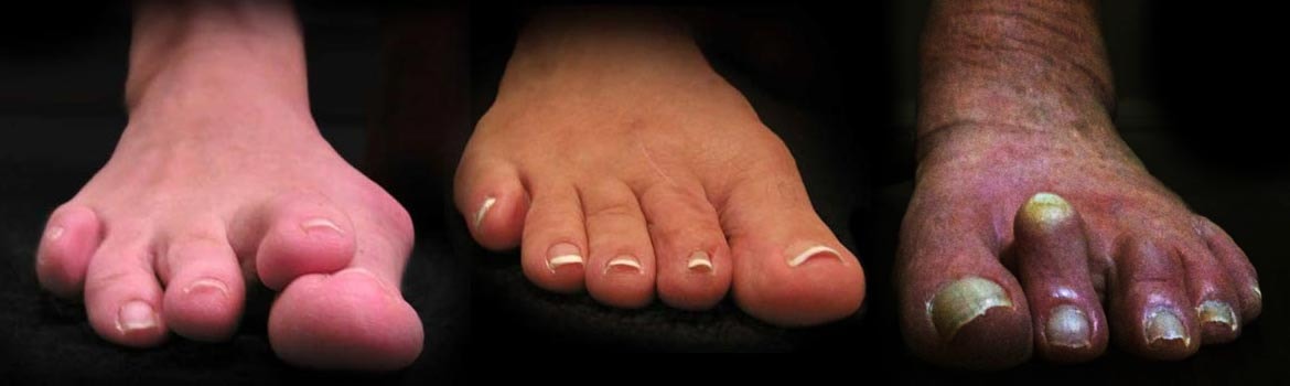 Three feet showing hammer toe deformity of the lesser toes
