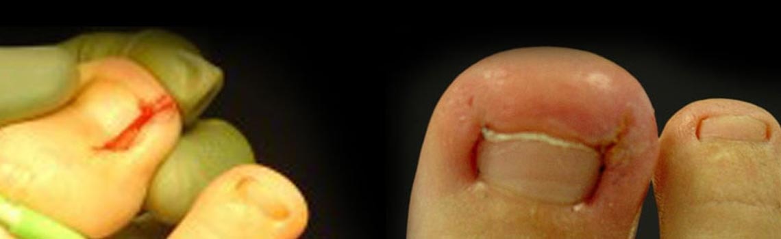 Two toes with ingrown toenails, one inflamed at the nail border