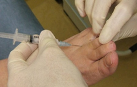 Clinician delivering an injection to the forefoot between the metatarsal heads