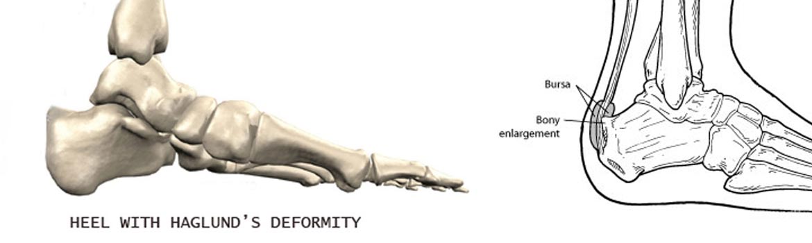 Haglund's Deformity: A Chiropractic Treatment Guide — ChiroUp