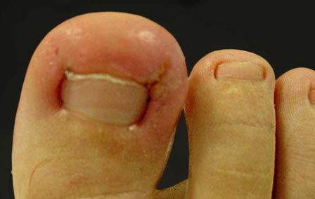 Ingrown Toenail | Manly Foot Clinic